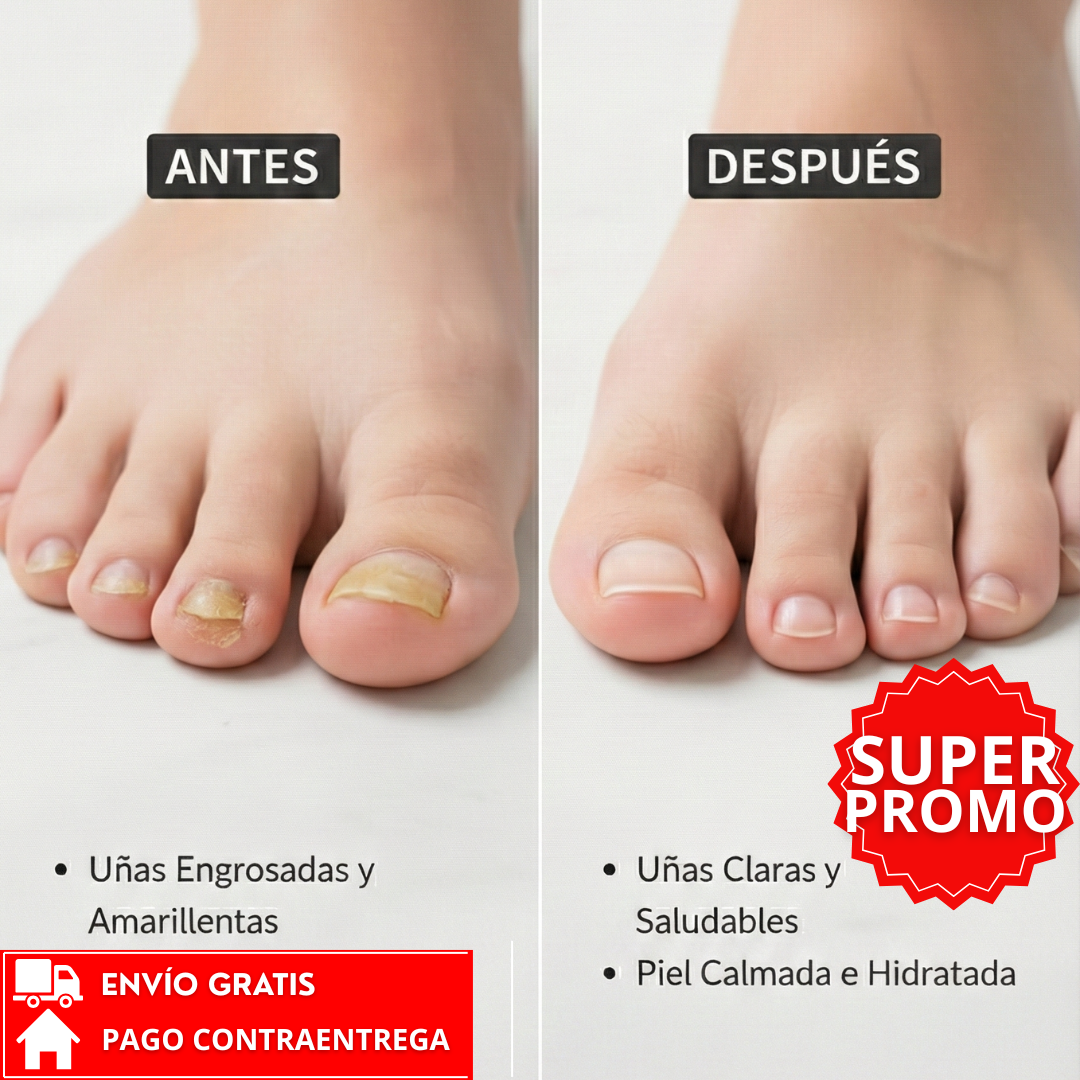 Oferta Especial 2x1: German ToenailPlus™ - Eliminador efectivo de hongos en las uñas.